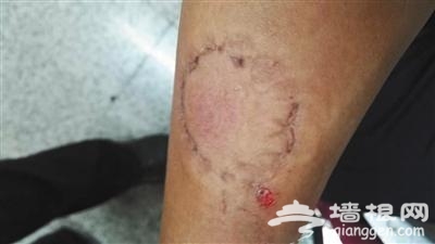 “地铁色狼”拒捕咬民警 10秒未松口